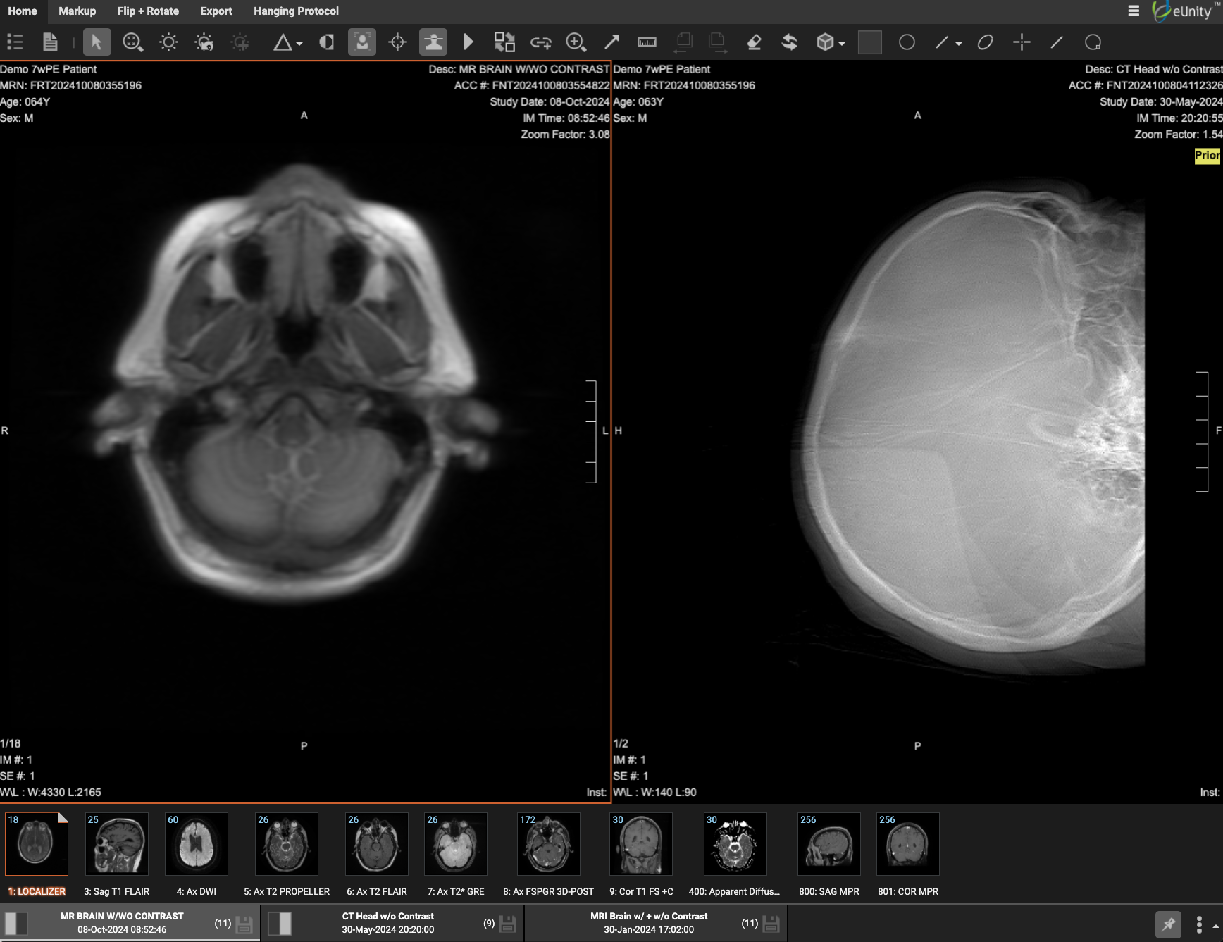 Synthesis viewer with current study and prior (demo data)